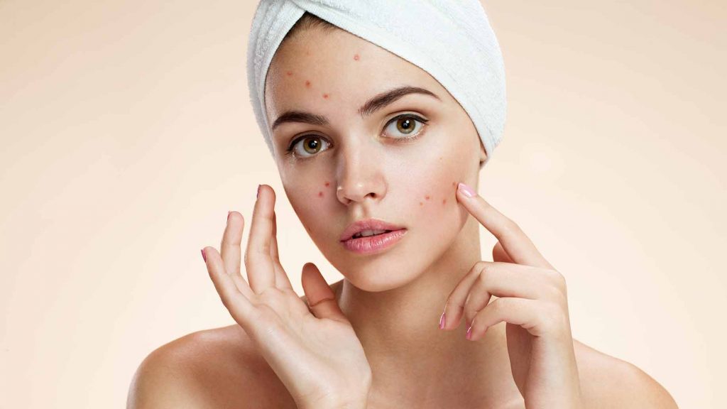 Skincare for acne. 