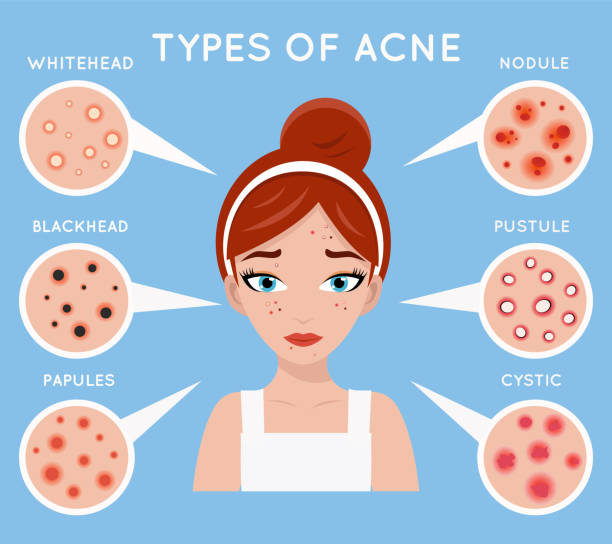 Types of Acne check for skincare routine for acne.