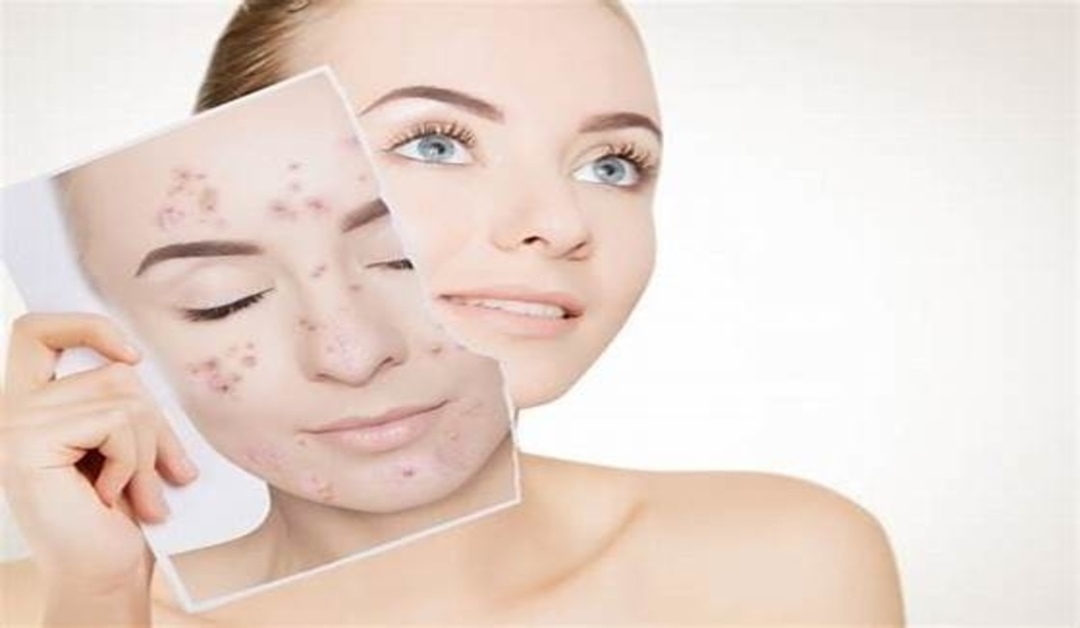 Skincare for acne
