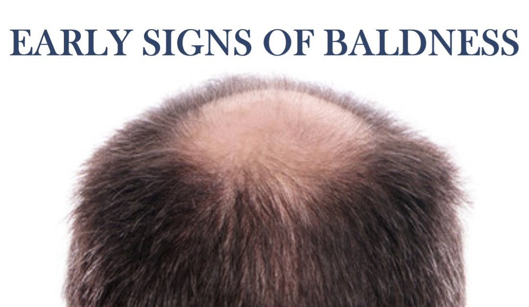 Early Signs of Baldness